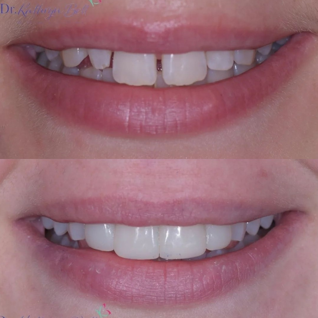 Composite Bonding