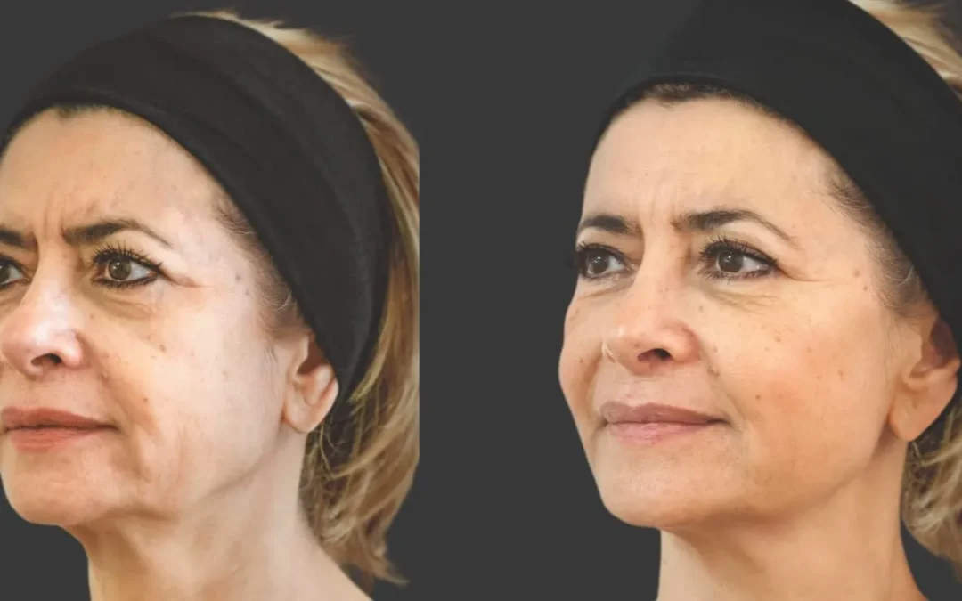 Discover the Power of Ellanse: The Next Generation of Biostimulation